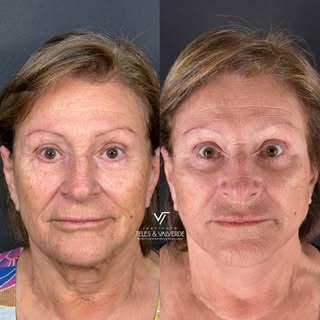 Deep Plane Face Lift | Antes & Depois

O rejuvenescimento facial vai além da aparência: trata-se de 