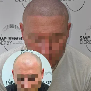 3 sessions complete! These are the HEALED results. 
Client opted for a clean, straight shape-up hair