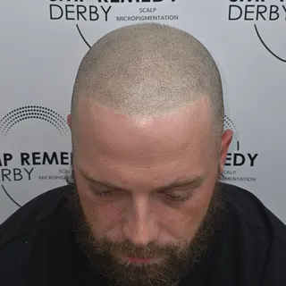 Hair transplant didn’t quite deliver… so we stepped in with SMP.
A cleaner hairline and more balance