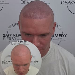 This client had previously undergone a hair transplant but still wasn't happy with the overall densi
