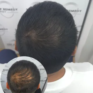 2 sessions. Natural results. 👌

This client wanted to reduce scalp visibility through the crown whi