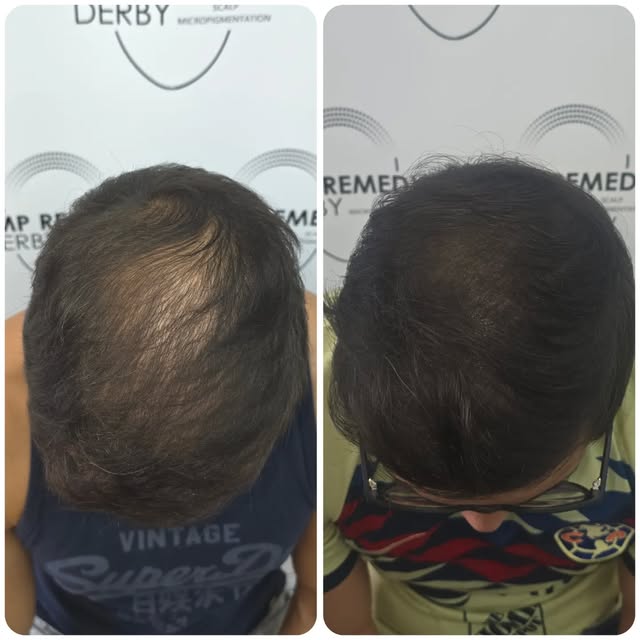 Hair density SMP 👌🏽

Reducing scalp visibility while keeping things looking natural.

Before ➡️ Af