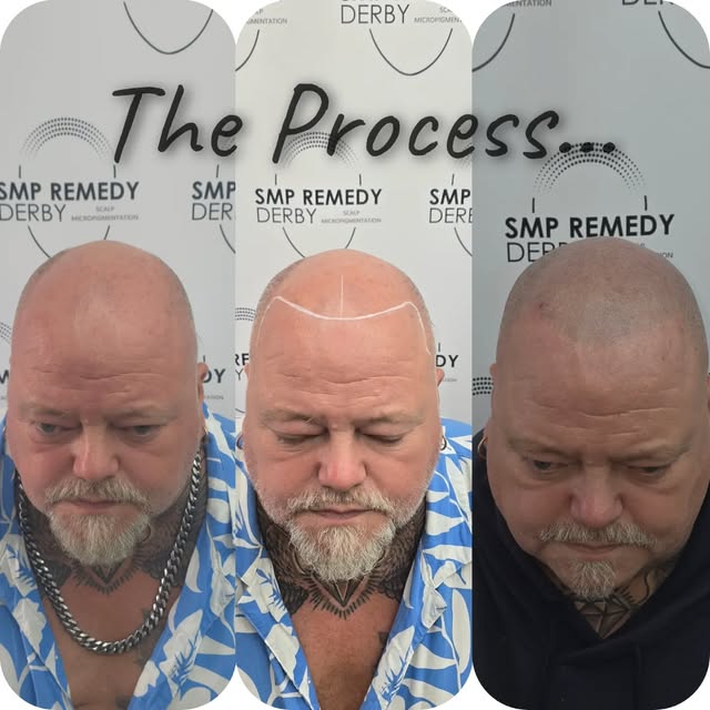 Shaved-look SMP 👌🏽

This treatment is designed to recreate the appearance of freshly shaved hair b