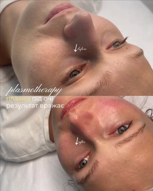 Плазмотерапія ✨

У Dr.Trichologist ми використовуємо різні види аутологічної плазми залежно від зада