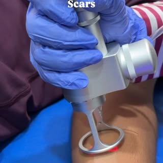 ✨ CO₂ Laser Scar Revision ✨

An advanced laser treatment designed to improve the appearance, texture