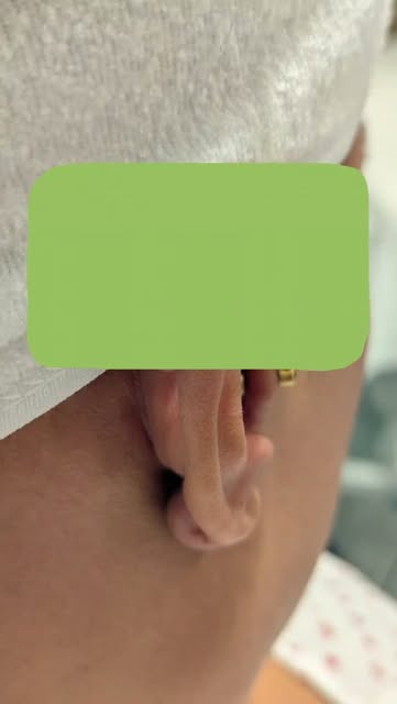 Keloid Scar Treatment at Nu-Health & Beauty Clinic
Concerned about a raised or thickened scar on you