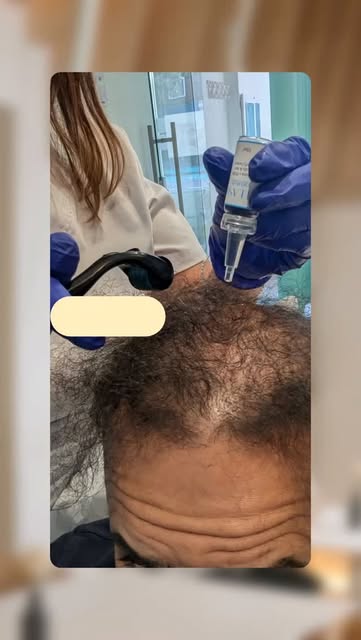 If you mean a microneedling scalp treatment using an exosome serum applied topically, without inject