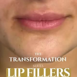 A subtle transformation, designed to enhance what’s already yours. 

Because the best lip filler res