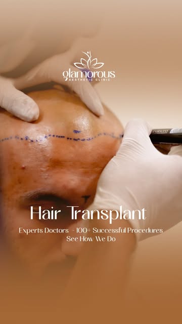 At Glamorous Aesthetic Clinic, our board certified plastic surgeon performs advanced hair transplant