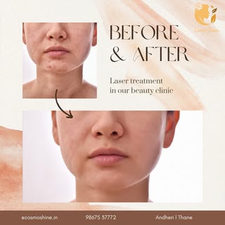 ✨ Transform Your Skin with Our Advanced Laser Treatments! ✨

Swipe to see the incredible results our