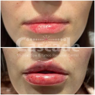 Immediately after lip filler! What bruising can look like after a full syringe with the #russiantech