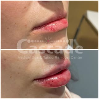These juicy lips were curated over two visits with Restylane Kysse! 💋
..
Visit our website to book 