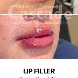 JUICY!! 🫦
#restylanekysse #lipfiller #kysse #kysseandtell #teethwhitening #bbl #beforeandafter #bef