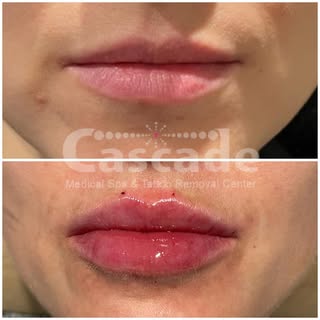 Before the first session of filler, and immediately after the most recent. These lips never looked o