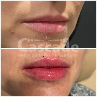 Natural lip augmentation at its finest! 
#lipfiller #juvederm #lipfillerbeforeandafter #lipblush #nu