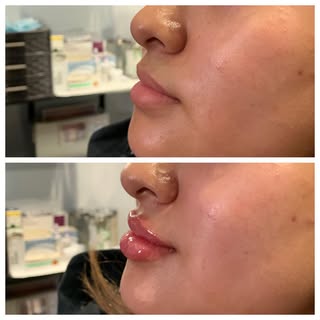 How beautiful are these lips? 👄 

👩🏻‍⚕️Provider: Teresa Rennels, RN
💉 Treatment: Lip Filler
🧪 P
