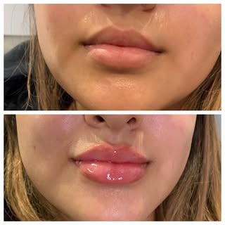 How beautiful are these lips? 👄 

👩🏻‍⚕️Provider: Teresa Rennels, RN
💉 Treatment: Lip Filler
🧪 P