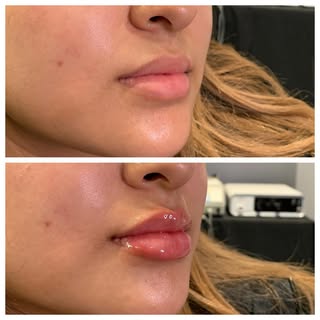 Her own lips, just a little juicier 👄 

👩🏻‍⚕️Provider: Teresa Rennels, RN
💉 Treatment: Lip Fille
