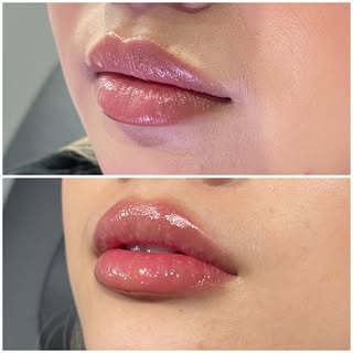 💋
..

👩🏻‍⚕️Provider: Amanda Nelson, RN, AES 
💉 Treatment: Lip Filler
🧪 Product: Half Syringe Vo