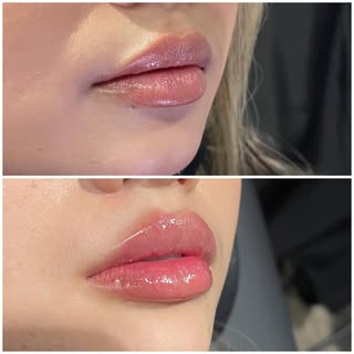 Luscious!
..

👩🏻‍⚕️Provider: Amanda Nelson,RN, AES
💉 Treatment: Lip Filler
🧪 Product: Half syrin