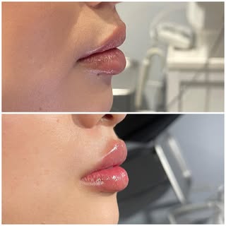 Yes please! 💋
..

👩🏻‍⚕️Provider: Amanda Nelson, RN, AES
💉 Treatment: Lip Filler
🧪 Product: Half