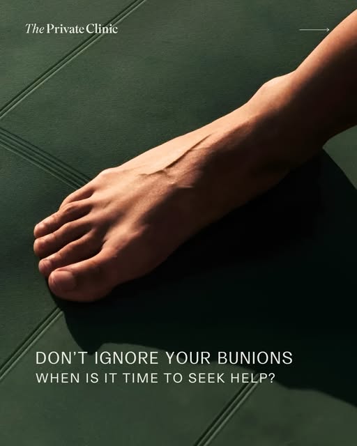 Bunions can become more than a cosmetic concern, particularly when pain or discomfort starts to affe