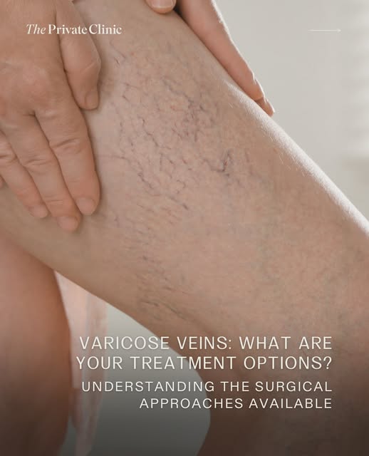 Are your Varicose Veins more than a cosmetic concern?

Varicose Veins can be associated with aching,