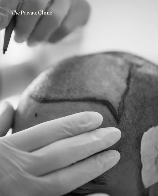 Considering a Hair Transplant?

A natural-looking result starts with careful planning. Dr Umair Khan