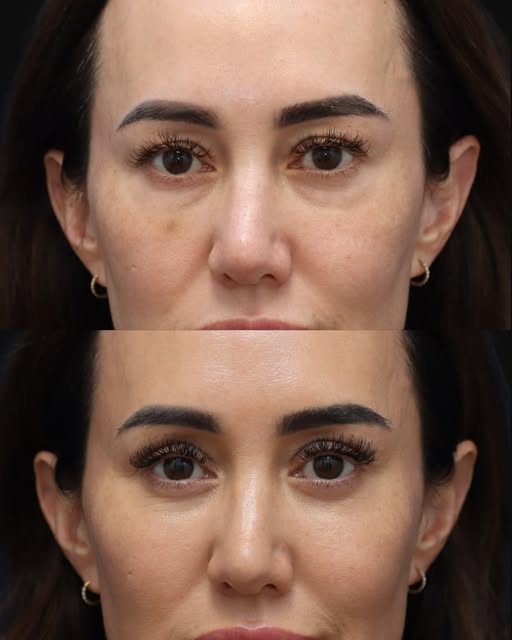 She’s an injector.
She knows filler better than almost anyone.
And she knew filler wasn’t the answer