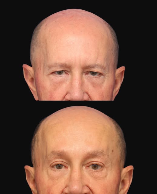 I’ll challenge you on this one: look closely and try to find the incision.

This patient came to me 