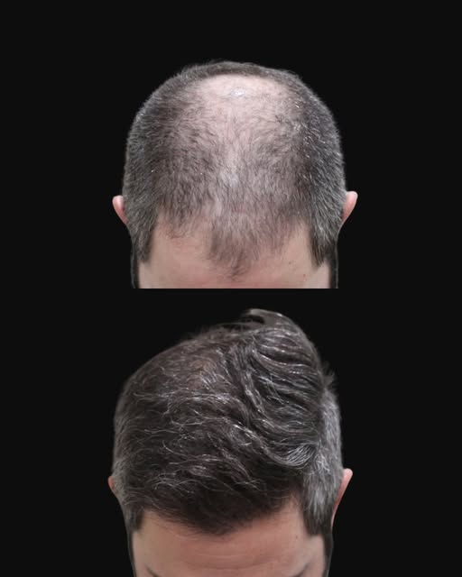 3,000 grafts. 7 months of growth. And we’re not at the finish line yet.

This patient came in wantin