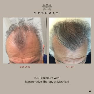 Advanced FUE at Meshkati Clinic 
We go beyond traditional hair transplants, combining 30+ years of e