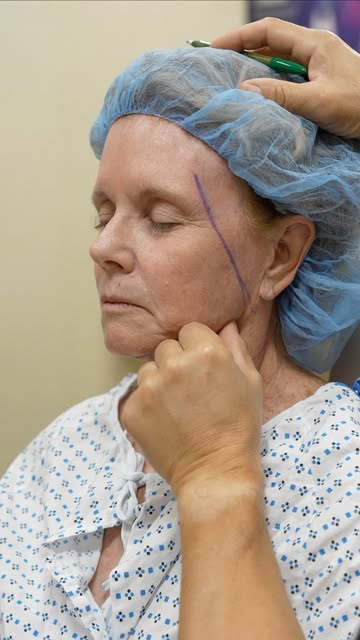 Post-op day one and healing beautifully! ✨

At 71, my lovely patient underwent a Deep Plane Face & N