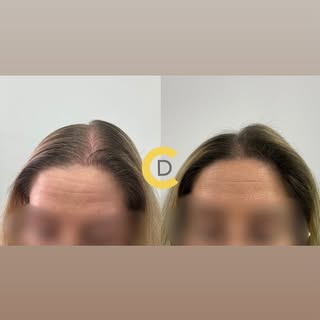 𝑨𝒍𝒐𝒑𝒆𝒄𝒊𝒂 𝑭𝒆𝒎𝒆𝒏𝒊𝒏𝒂

👩‍⚕️ La alopecia androgenética femenina es mucho más frecuente d