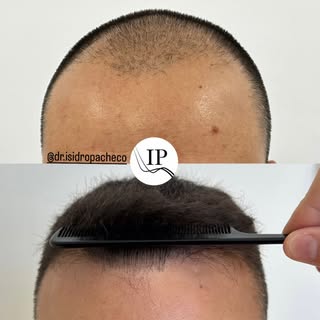 𝐓𝐫𝐚𝐬𝐩𝐥𝐚𝐧𝐭𝐞 𝐂𝐚𝐩𝐢𝐥𝐚𝐫 

Caso de éxito 💥

👨 Varón joven con alopecia grado IV.

💊 Tr
