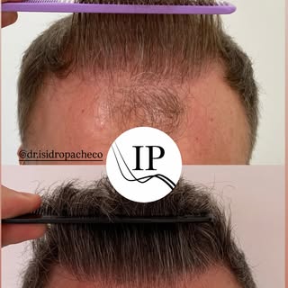 ✨ ¿Te hiciste un injerto y no obtuviste el resultado que esperabas?

Este paciente llegó a nuestra c