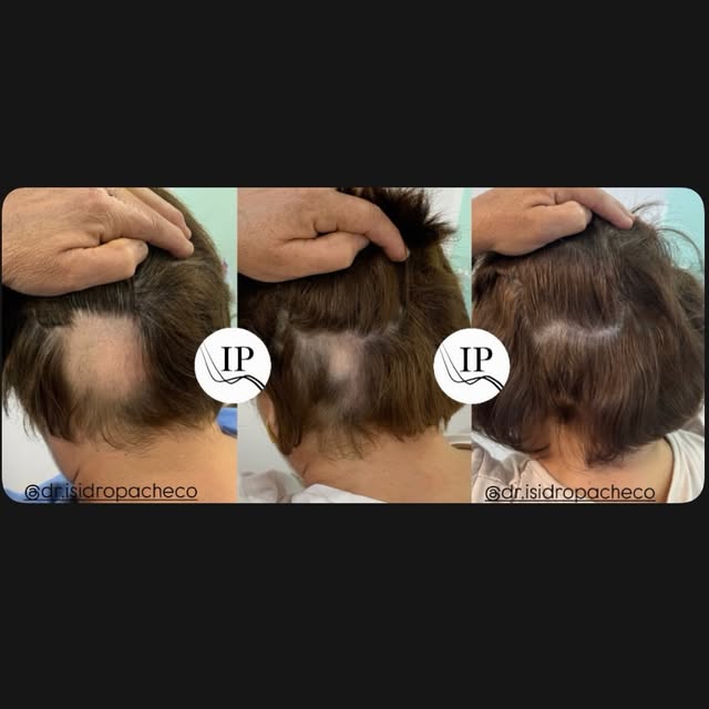 𝐀𝐥𝐨𝐩𝐞𝐜𝐢𝐚 𝐀𝐫𝐞𝐚𝐭𝐚

✨ Alopecia areata: el diagnóstico y el tratamiento precoz son fundame