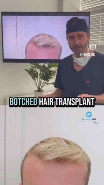 Repairing A Botched Hair Transplant

Dr. Andre Nel Hair Transplant Clinic 

Let hear from Dr. Andre 