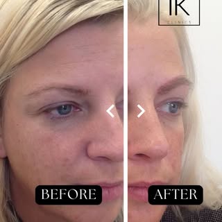 What a transformation!

Whether you've lost brows due to over-plucking, alopecia, scarring, or thinn