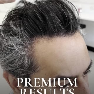 #hairtransplant #hairrestoration #fuehairtransplant #hairloss #hairtransformation