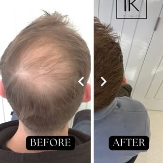 You can’t see his smile but we can promise you, it is big and bright! 

For many men, a hair transpl