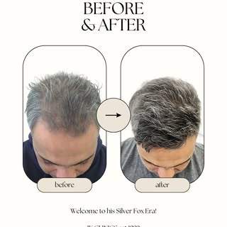 From thinning to thriving. Say hello to his Silver Fox era.

This client came to us in Leicester rea