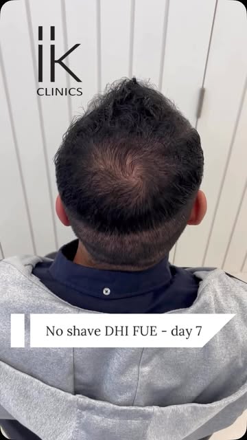 #hairtransplant #fuehairtransplant #hairloss #hairlosstreatment #hairtransplantuk