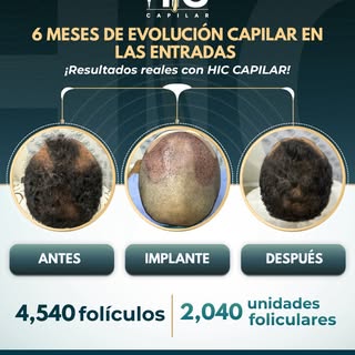 6 meses después, sus entradas ya cuentan otra historia. 💙

Con más de 4.500 folículos implantados, 