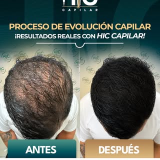 Con 2.536 unidades foliculares, este paciente recuperó la densidad de su cabello y, con ella, su con