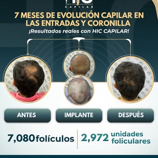 7 meses después, el cambio se nota y la naturalidad también. 💙

Un resultado que busca recuperar la