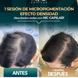 ¿Te gustaría que tu cabello se viera con más densidad sin hacerte un implante? 👀

Con una sesión de