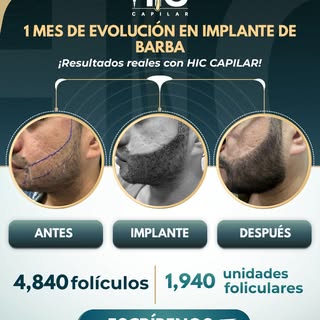 Sí, también puedes transformar tu barba. 👀

El implante de barba permite trabajar zonas con poca de