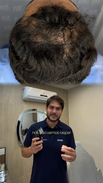 Você faria um transplante capilar se não precisasse raspar o cabelo? 👀

Em alguns casos, isso é pos