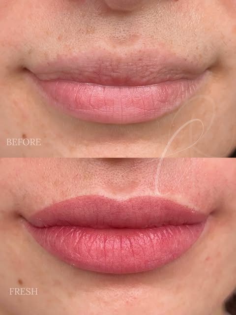 Pale, uneven lips lacking definition? Sculpted Lips 👄

Right after the procedure, the color looks m